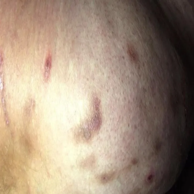 Zdjęcia zmiany skórne przeczosy 
