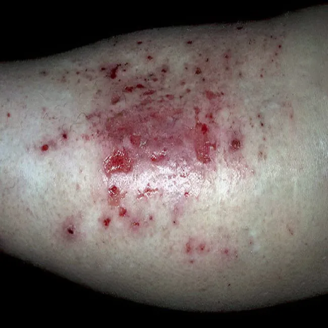 Zmiany na skórze przeczosy skórne psychogenne