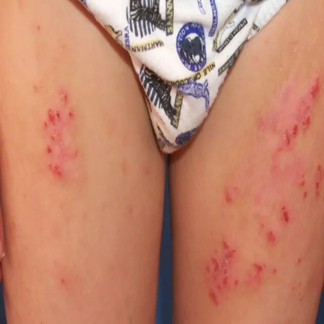 przeczosy u dzieci na nogach