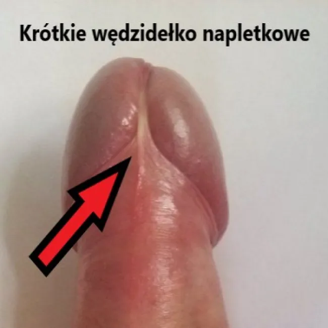 za krótkie wędzidełko napletkowe