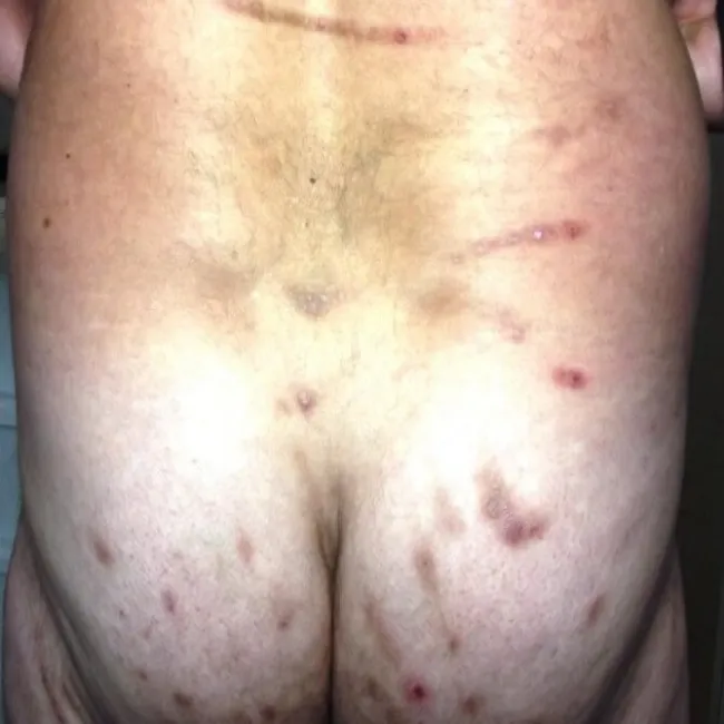 zmiany skórne na pośladkach przeczosy