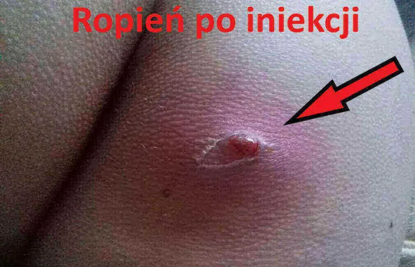 Ropień po iniekcji