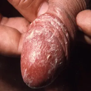 BXO – balanitis xerotica obliterans