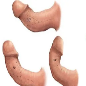 Choroba Peyroniego skrzywienie prącia