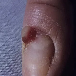 Choroby paznokcia palca u ręki ziarniniak