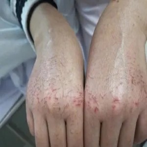 Objawy po noszeniu rękawiczek z lateksu