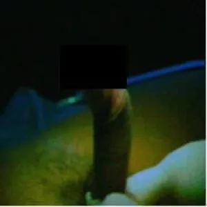 Peyronie disease