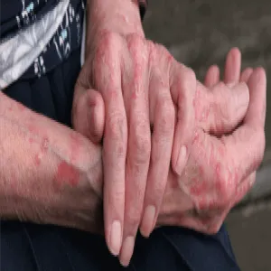 Plamy na rękach i dłoniach pelagra