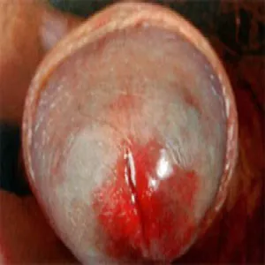 balanitis of Zoon