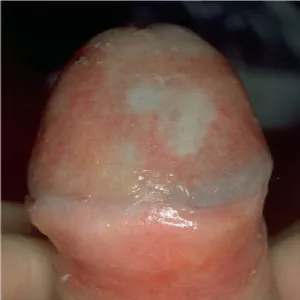 balanitis plasmacellularis Zoon