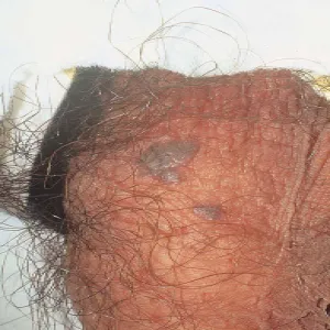 bowenoid papulosis