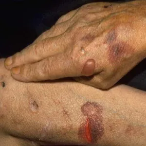 porphyria cutanea tarda – PCT
