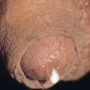 tryper choroba