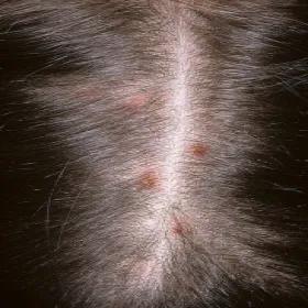 Świąd skóry głowy przeczosy