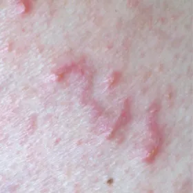 Świerzb przeczosy zdjęcie