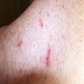 ślady zadrapań przeczosy 