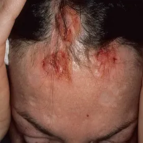 Drapanie głowy na tle nerwowym przeczosy