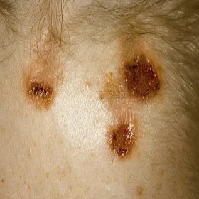 Drapanie skóry głowy choroba przeczosy