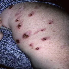 Drapanie z nerwów przeczosy