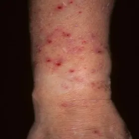 Nerwica pieczenie skóry przeczosy