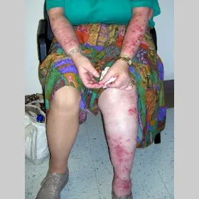 Nerwica skóry przeczosy