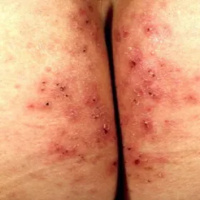 Przeczosy psychogenne na pośladkach