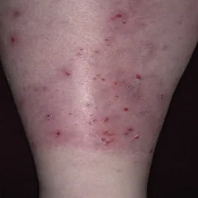 Przeczosy skórne psychogenne na łydce