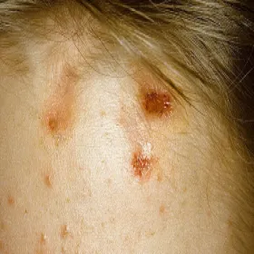 Rany na głowie od drapania przeczosy