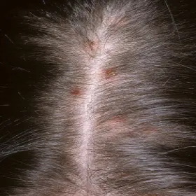 Swędząca skóra głowy  krostki przeczosy