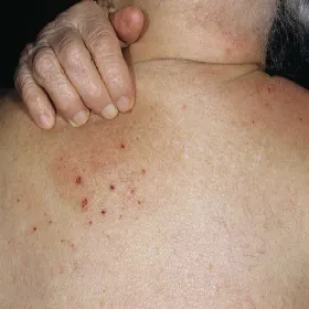 Swędzenie skóry na tle nerwowym przeczosy