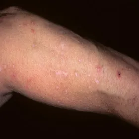 Zdjęcia zmian skórnych przeczosy