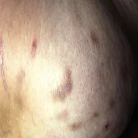 Zdjęcia zmiany skórne przeczosy 