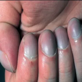 clubbed fingers