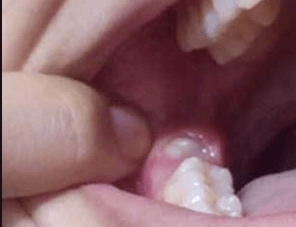 Pojawienie się ropy po wyrwaniu zęba