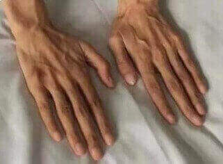 Zespół Marfana (arachnodaktylia, pająkowatość palców)