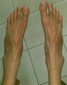 Zespół Marfana długie i smukłe stopy