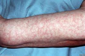 Zespół antyfosfolipidowy 