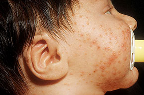 trądzik niemowlęcy zdjęcia