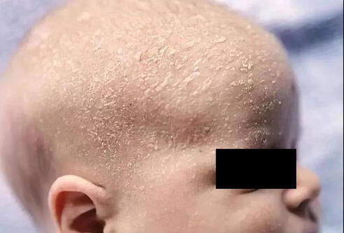 Łojotokowe zapalenie skóry głowy