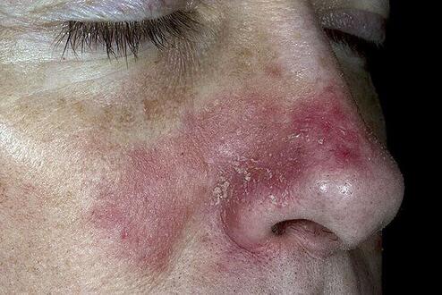 Łojotokowe zapalenie skóry na twarzy