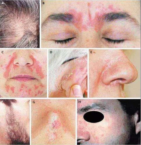 Łojotokowe zapalenie skóry zdjęcia