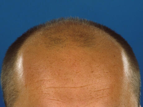 łysienie androgenowe u mężczyzn zdjęcie