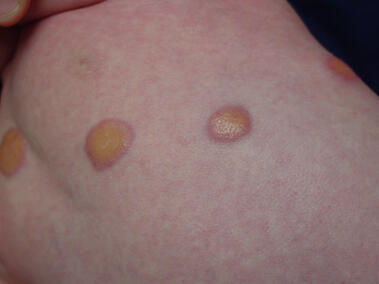 Żółtakoziarniniakowatość młodzieńcza zdjęcie