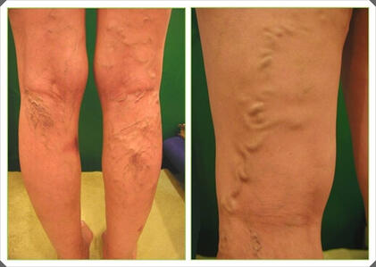 żylaki kończyn dolnych zdjęcie