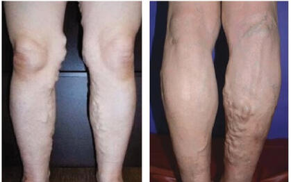 żylaki na nogach zdjęcia