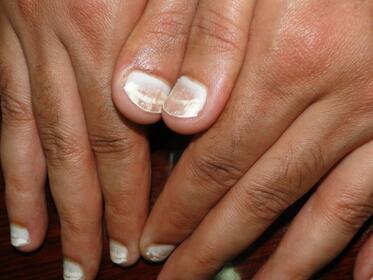 Białe linie na paznokciach 