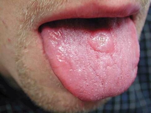 Choroba kiła język