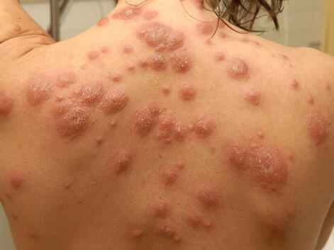 Choroba ostra gorączkowa dermatoza neutrofilowa 