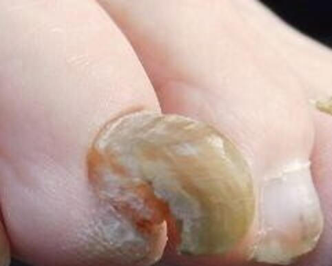 Choroba paznokci ptasi pazur