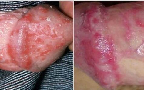 Choroba prącia balanitis 